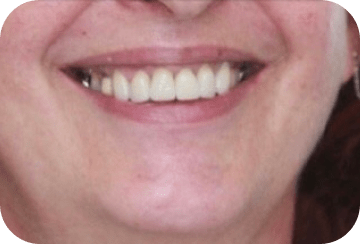 Photo de la dentition après la mise en place d'une couronne dentaire au cabinet du docteur Georget