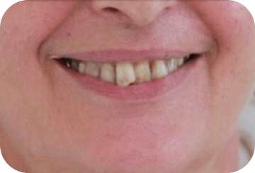 Photo de la dentition avant la mise en place d'une couronne dentaire au cabinet du docteur Georget