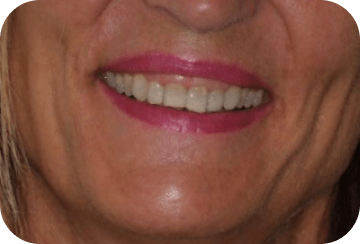 Photo de la dentition après un éclaircissement dentaire au cabinet du docteur Georget