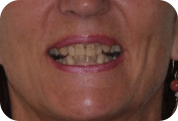 Photo de la dentition avant un éclaircissement dentaire au cabinet du docteur Georget