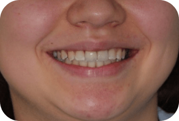 Photo de la dentition après la mise en place de facettes dentaires au cabinet du docteur Georget