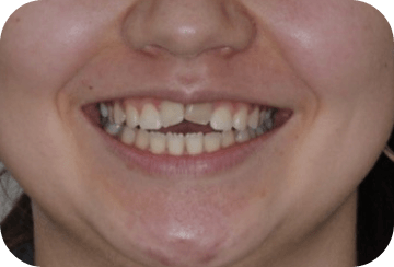 Photo de la dentition avant la mise en place de facettes dentaires au cabinet du docteur Georget